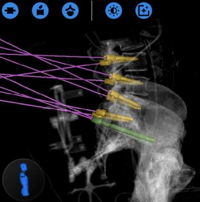 Beyond Placement of Pedicle Screws - New Applications for Robotics in Spine Surgery: A Multi-Surgeon, Single-Institution Experience